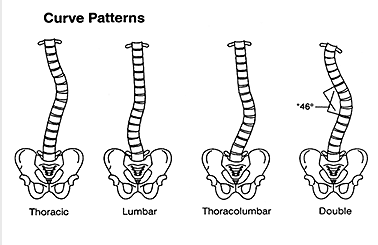 types of scoliosis